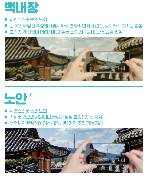 Puresee: The Latest Cataract Lens Customized for Koreans 사진 2