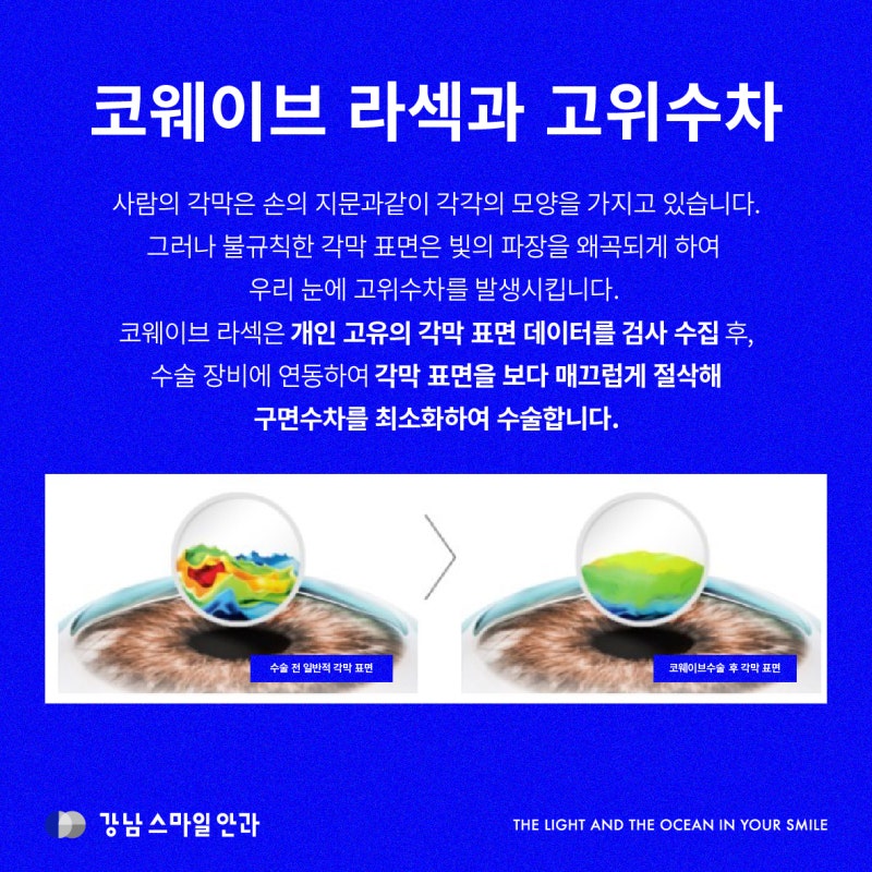 [시력교정술의 비밀] 근시 난시만 없애는 게 중요한 게 아니라구요? (Feat.고위수차와 저위수차) 사진 4