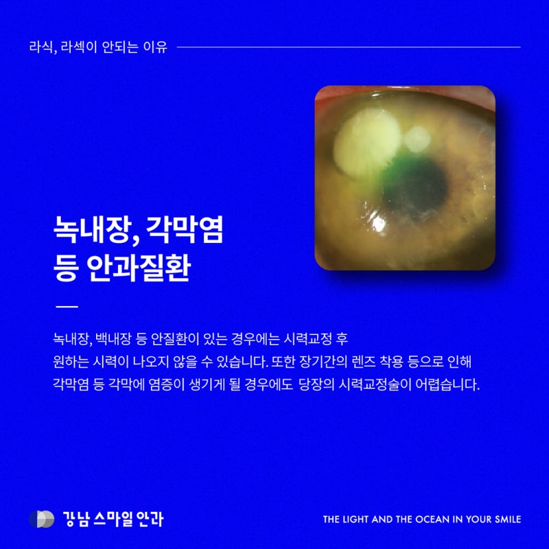Chắc tôi không thể phẫu thuật LASIK, LASEK? Các trường hợp không thể và giải pháp thay thế 사진 5