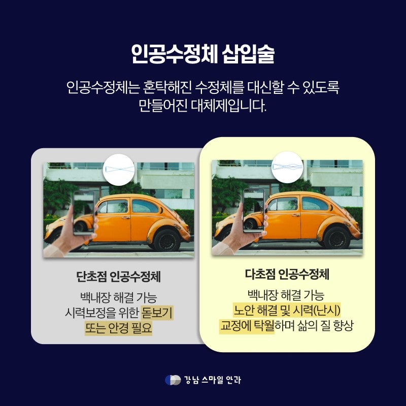 白內障種類不同，手術的黃金時間為何？