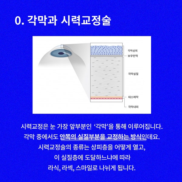 スマイルラシックとラセックの違い、スマイルラシックの副作用 | 江南スマイルラシックの費用 사진 2
