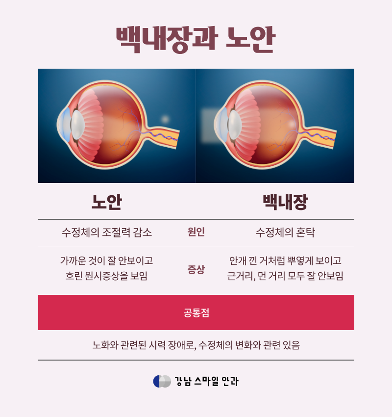 江南站老花眼治療，沒有白內障但視線模糊？需與「這個」區分！ 사진 2