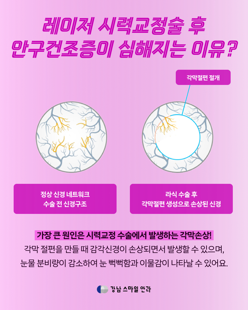 IPL ดวงตา | เหตุผลที่ต้องดูแลอาการตาแห้งหลังทำ Smile LASIK (เคล็ดลับในชีวิตประจำวัน) 사진 2