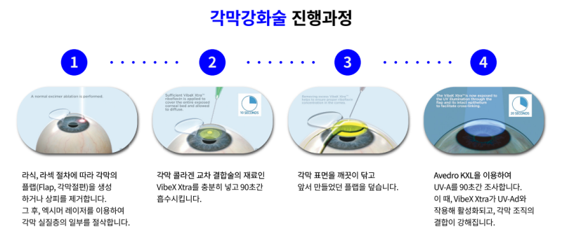 스마일라식 후 재발 방지를 돕는 '각막강화술' 이란? 사진 4