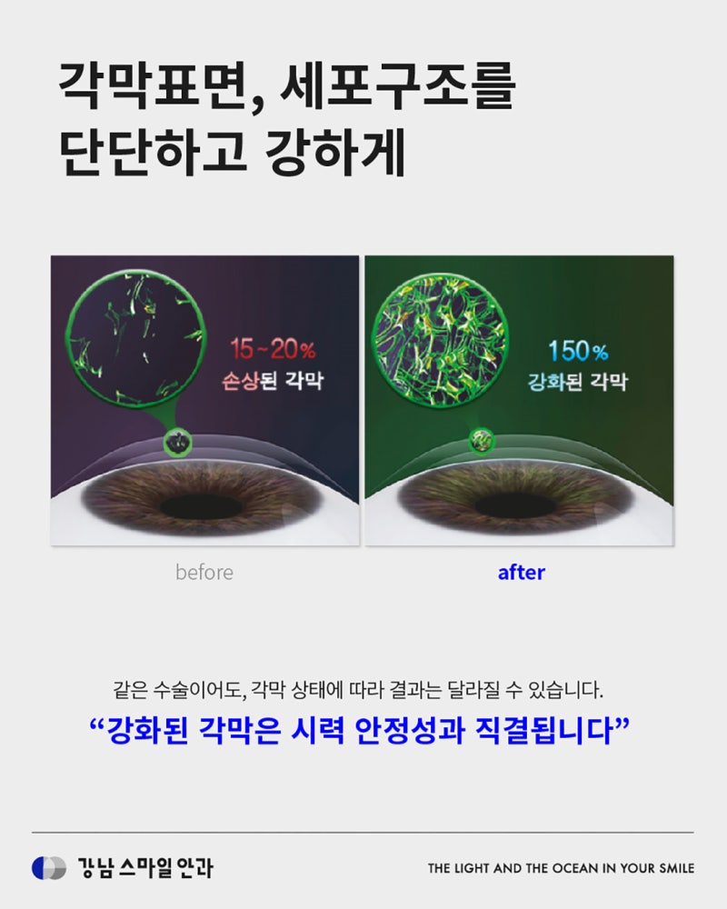 시력퇴행을 방지하는 각막강화술이란? | 강남역안과 사진 5