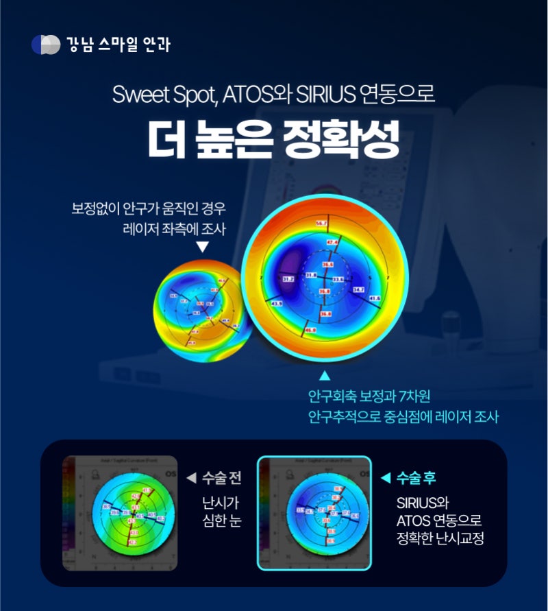江南站眼科Smart LASIK的区别 (Feat.什么是New Smile LASIK?) 사진 4