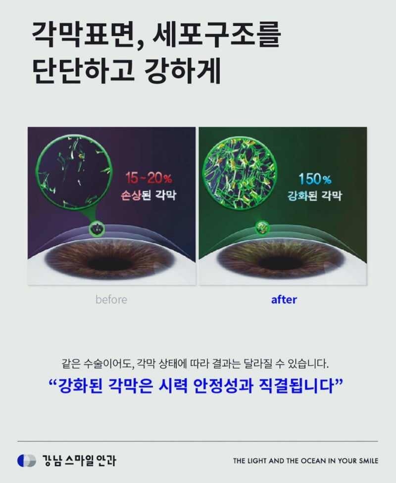 Hiệu quả của phẫu thuật tăng cường giác mạc, có nhất thiết phải làm không? | Phòng khám mắt Gangnam Station 사진 5