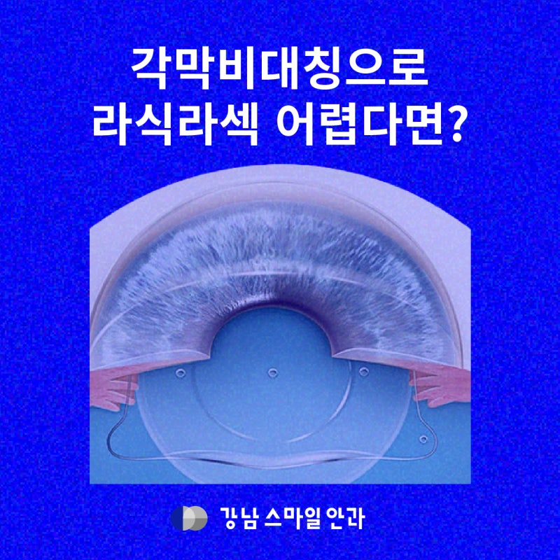 レーシック・ラゼックが難しいなら?角膜を温存するICL | レンズ挿入術が得意なクリニック