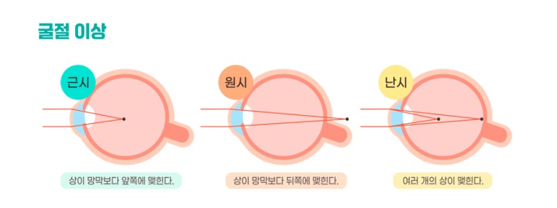 Smart Nova LASIK與SMILE微創手術有何不同？從散光矯正到角膜切削全面解析 사진 2