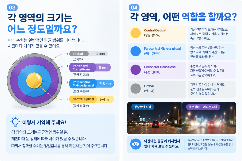 강남역투데이라섹, 동공 크기가 크다면 꼭 알아야할 3가지